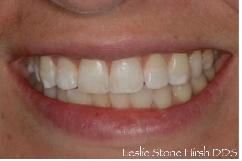 Bleaching and Bonding