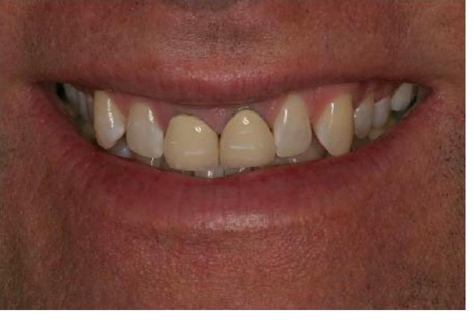 Bleaching and Crowns