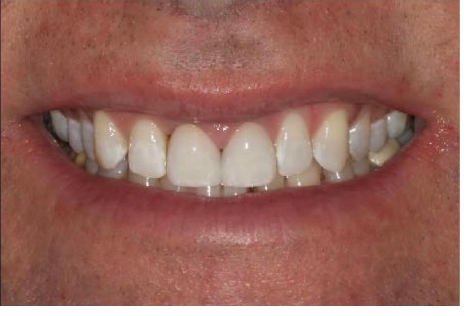 Bleaching and Crowns