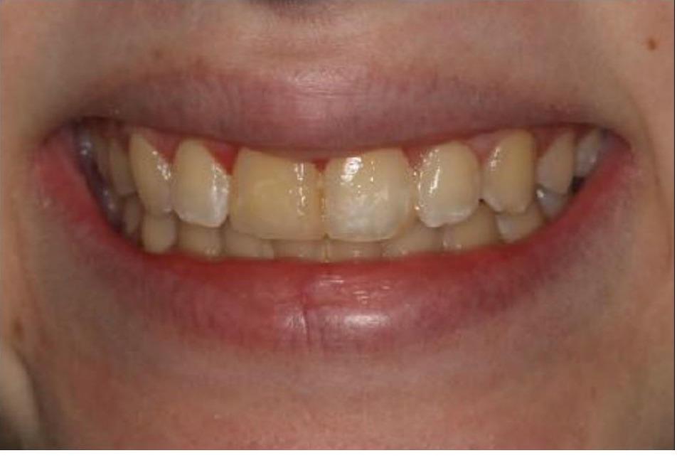 Bleaching and 1 Veneer