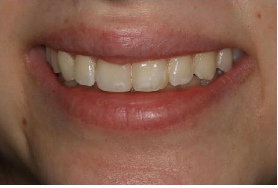 Bleaching and 1 Veneer