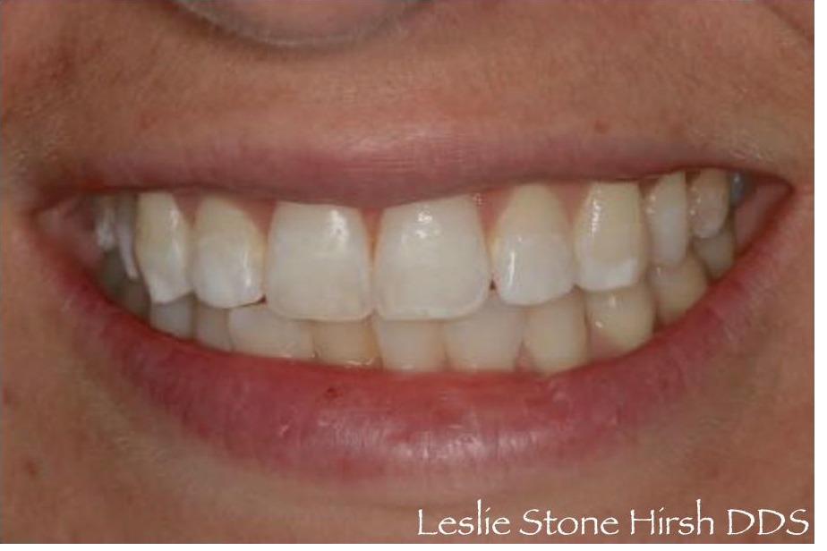 Bleaching and Bonding