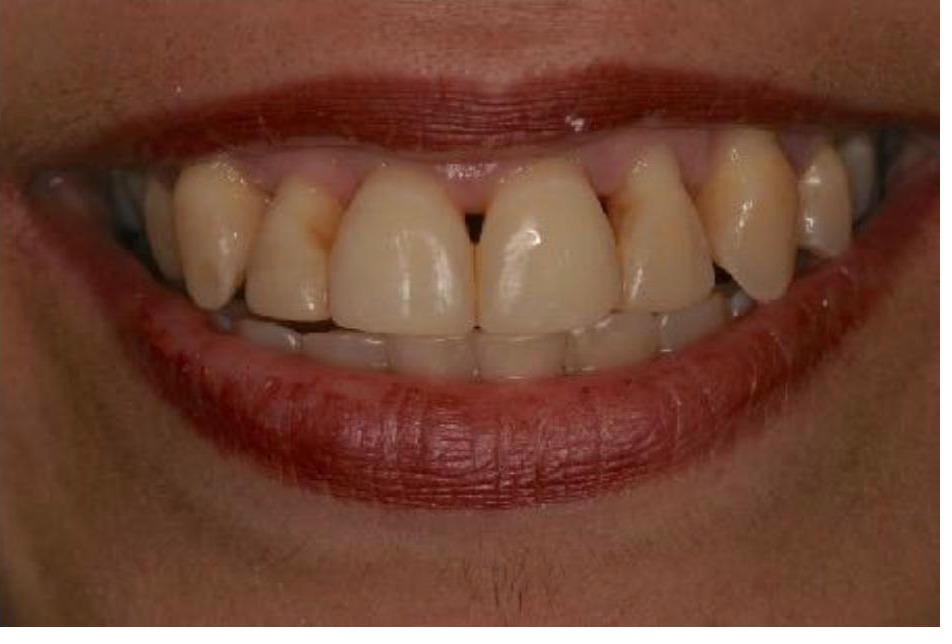 Bleaching and Bonding