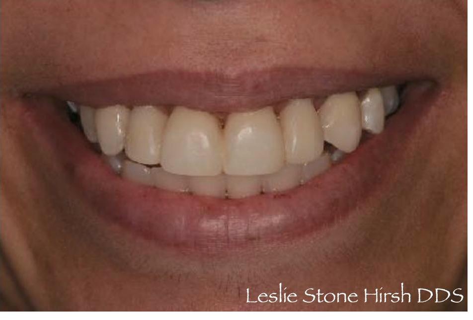 Bleaching and Bonding