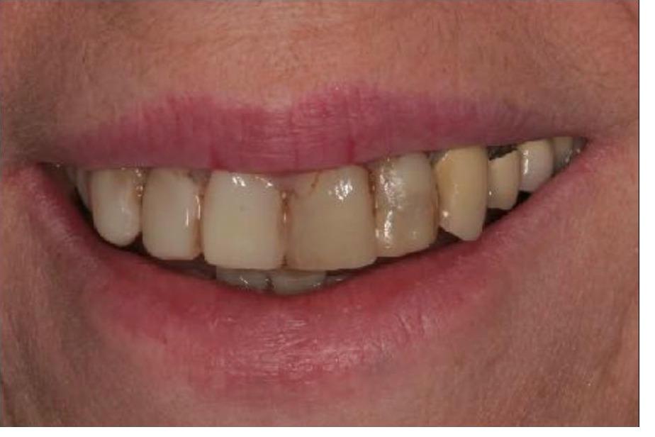 Crowns and Implant Crowns