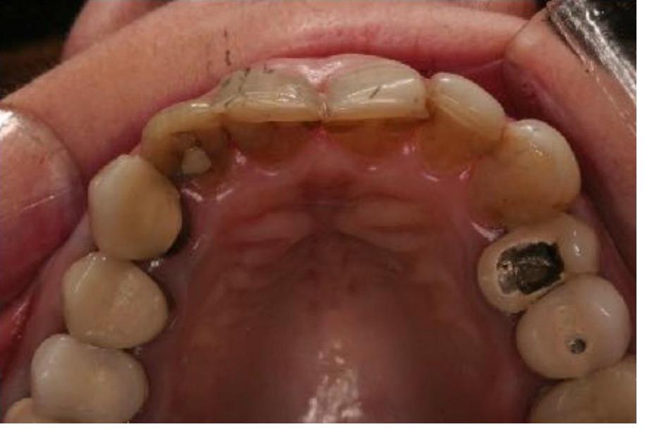 Crowns and Implant Crowns