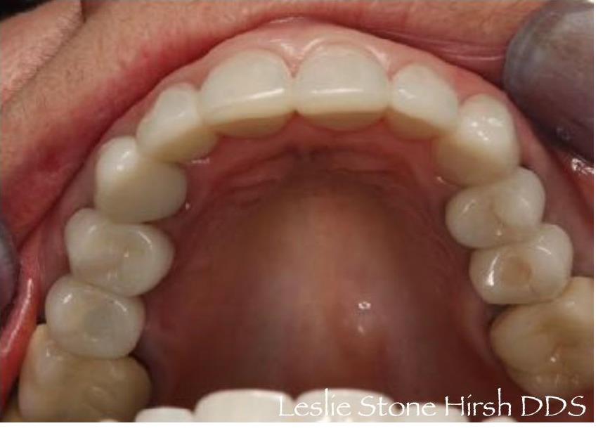 Crowns and Implant Crowns