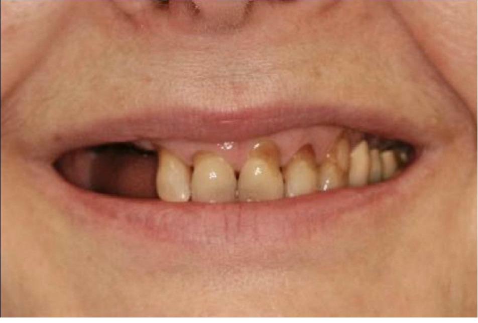 Full Mouth Rehabilitation