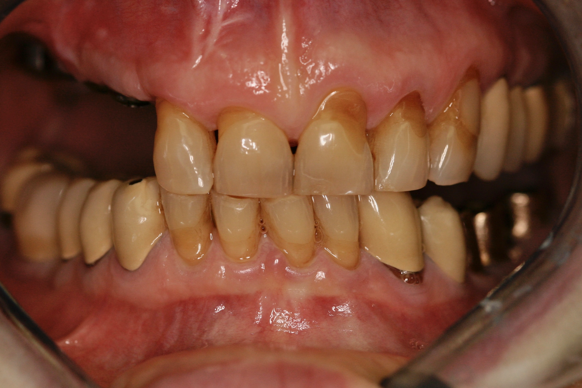 Full Mouth Rehabilitation