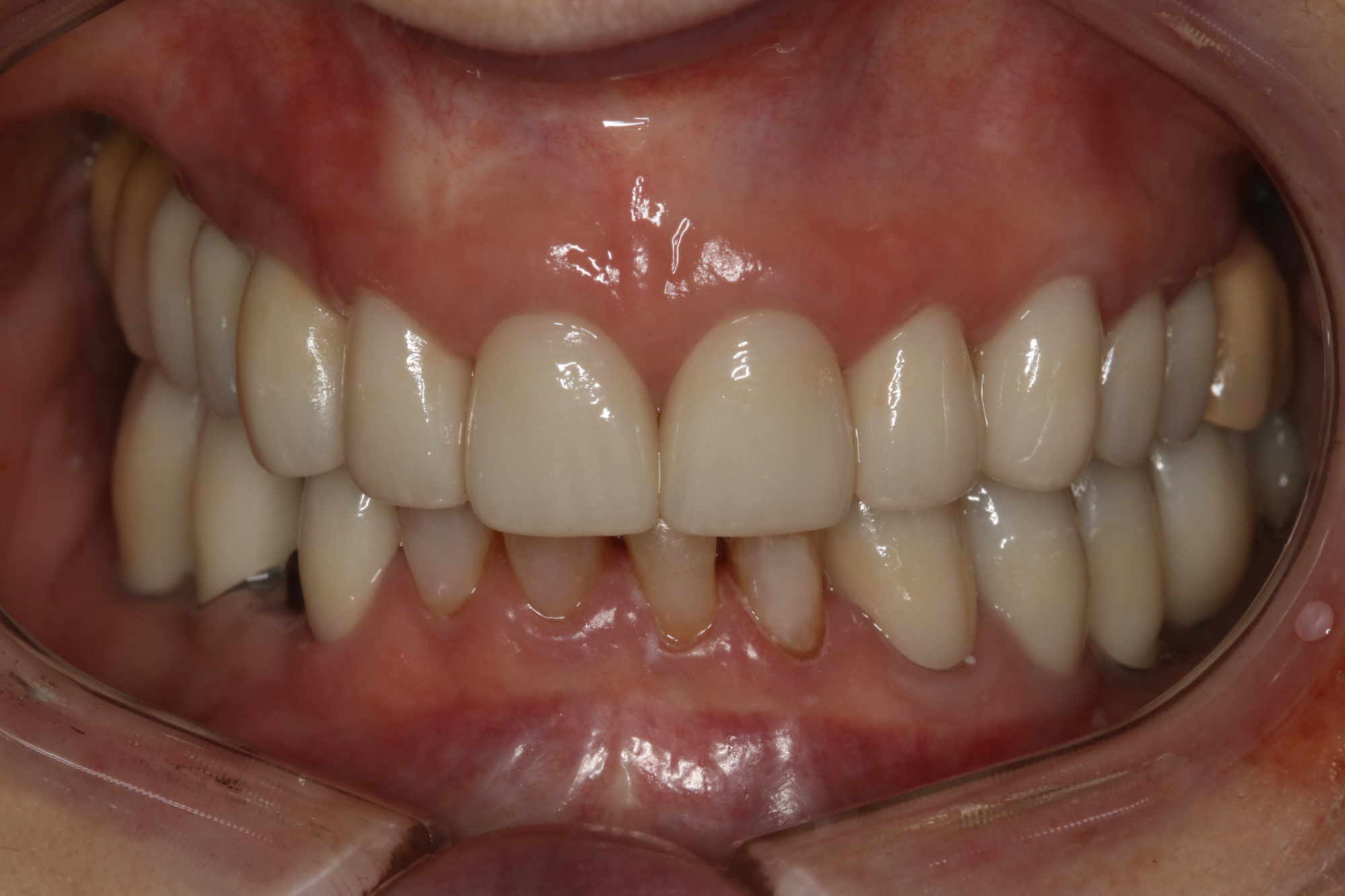 Full Mouth Rehabilitation