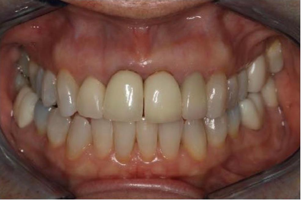 Crowns and Implant Crown