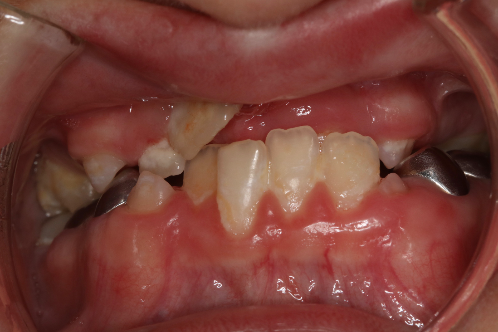 Upper Denture