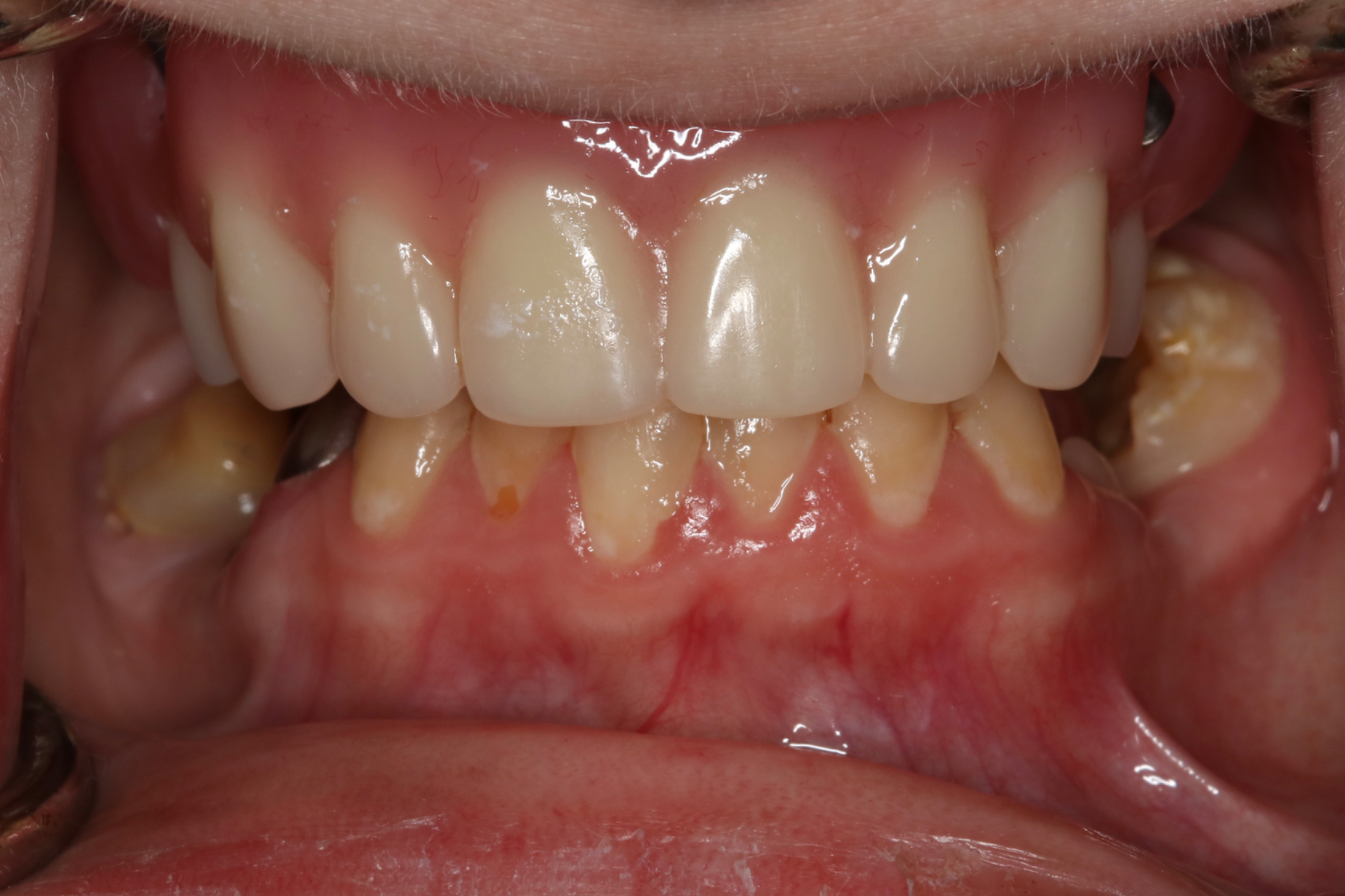 Upper Denture