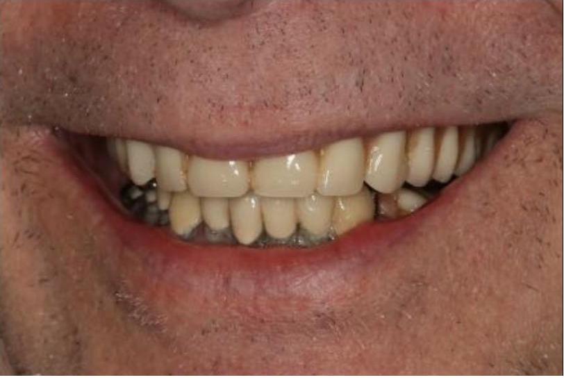 Upper Denture, Lower Implant Bridge