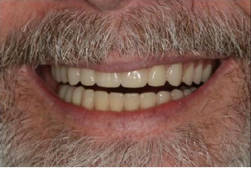 Upper Denture, Lower Implant Bridge