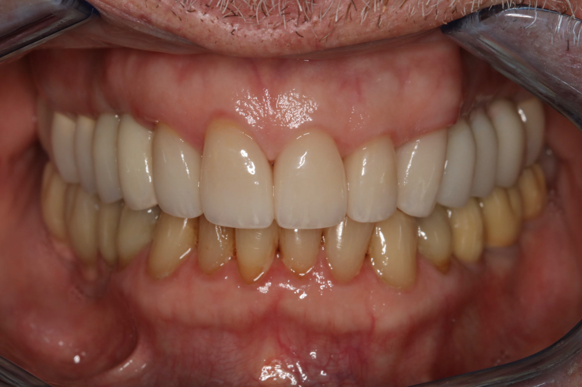 Full Mouth Rehabilitation