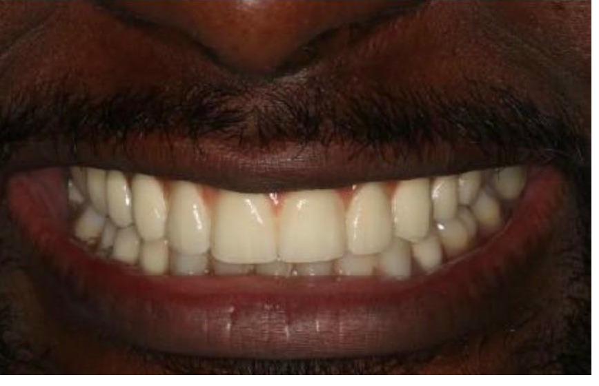 Full Mouth Rehabilitation