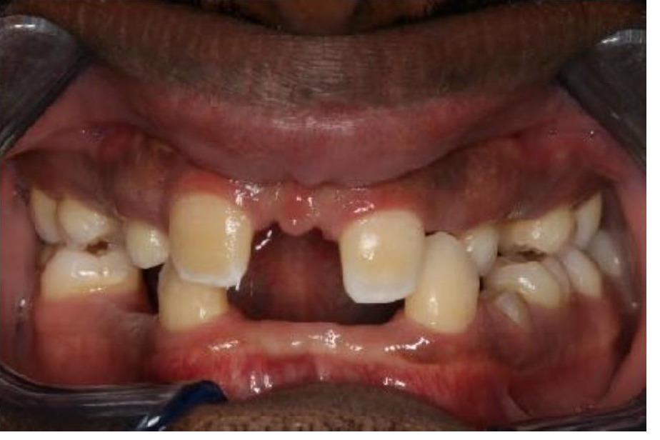 Full Mouth Rehabilitation