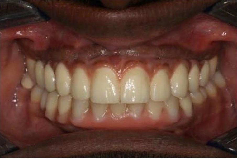 Full Mouth Rehabilitation