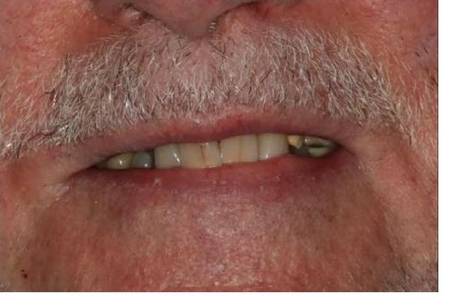 Full Mouth Rehabilitation