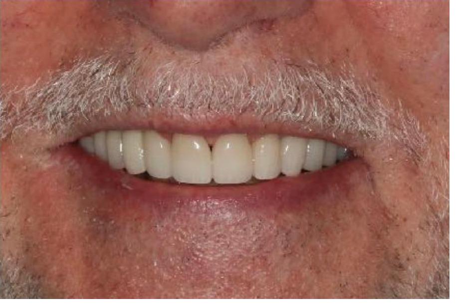 Full Mouth Rehabilitation