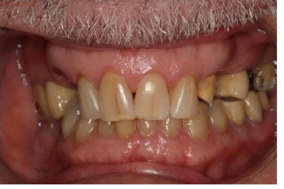 Full Mouth Rehabilitation