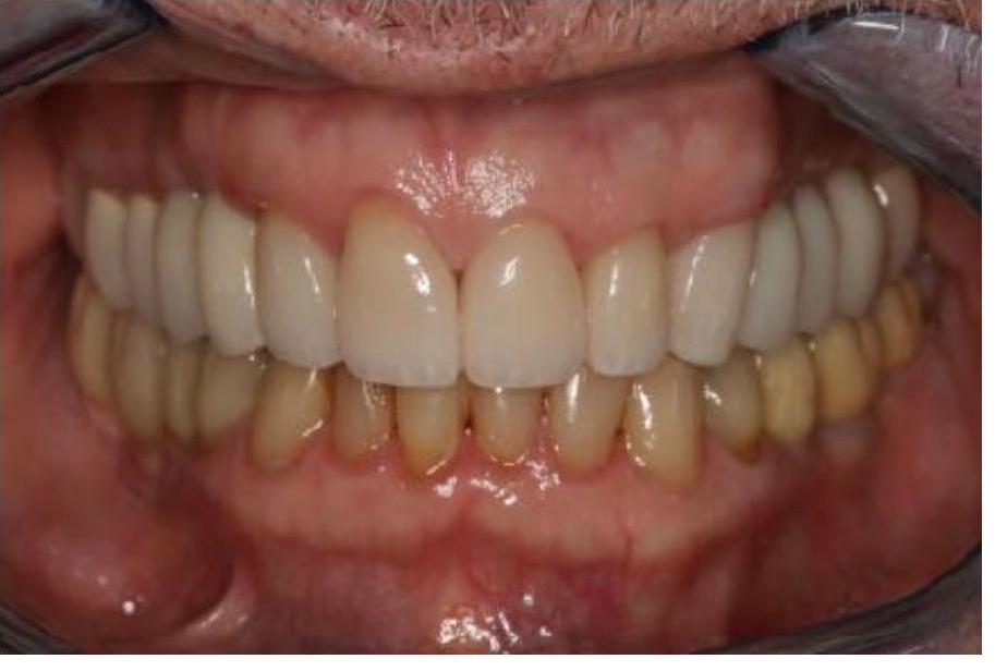 Full Mouth Rehabilitation