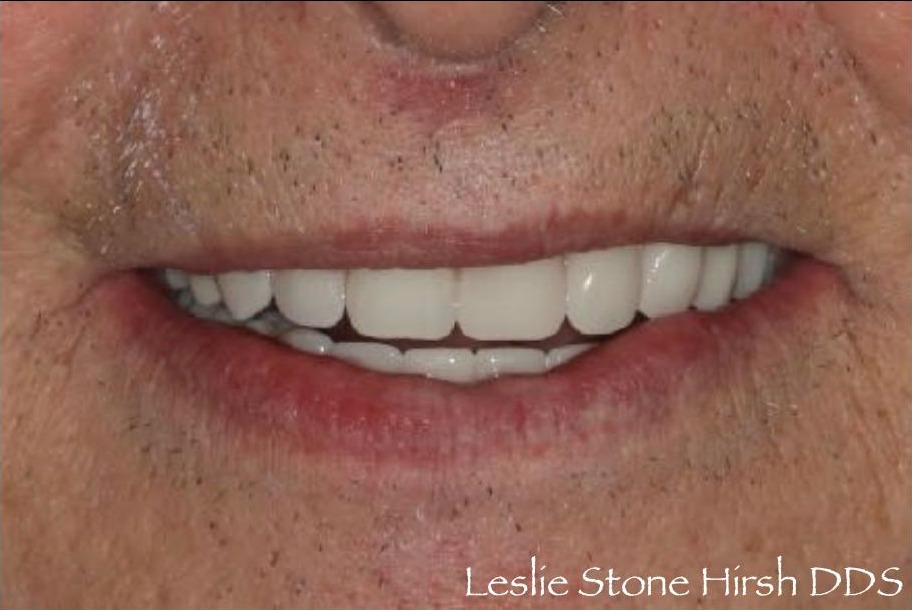 Full Mouth Rehabilitation