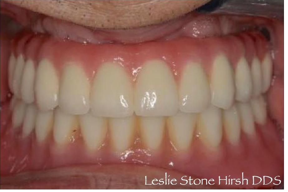 Full Mouth Rehabilitation