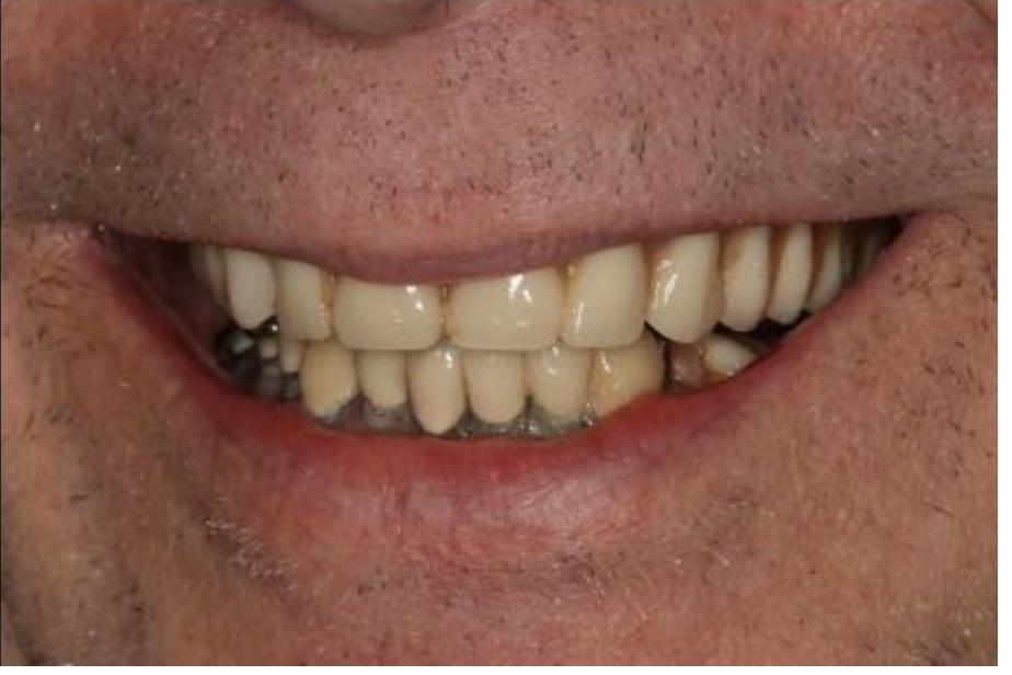Full Mouth Rehabilitation