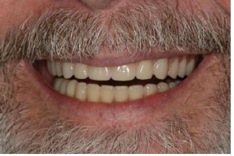 Full Mouth Rehabilitation