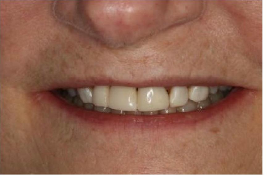 Full Mouth Rehabilitation