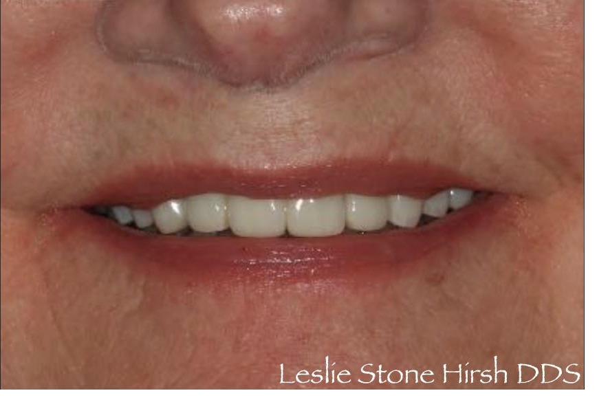 Full Mouth Rehabilitation