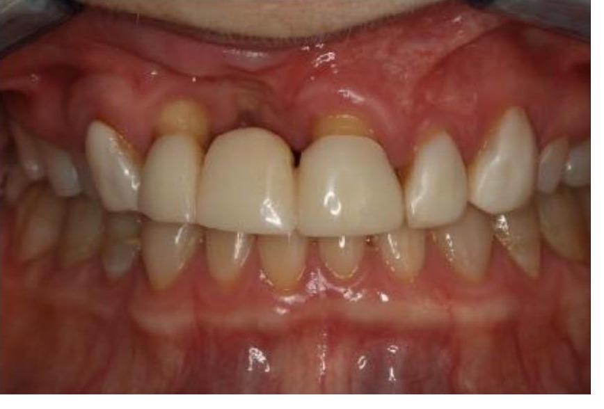 Full Mouth Rehabilitation