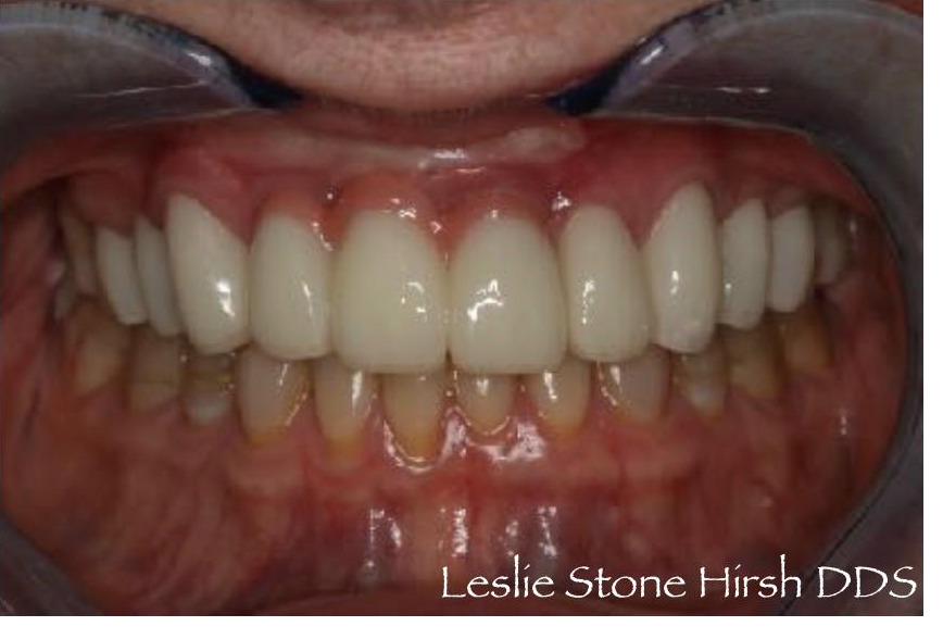 Full Mouth Rehabilitation