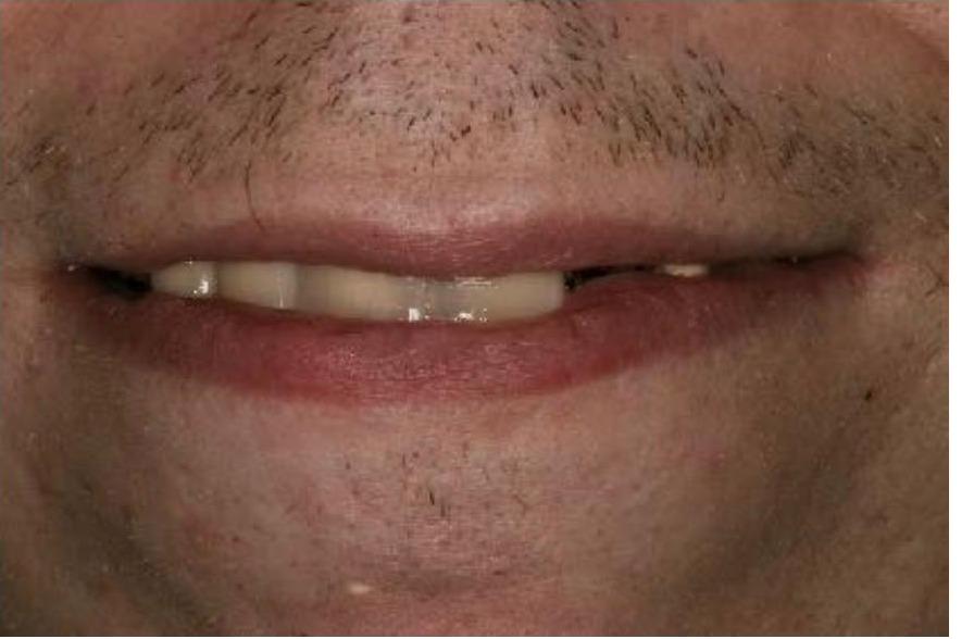 Full Mouth Rehabilitation