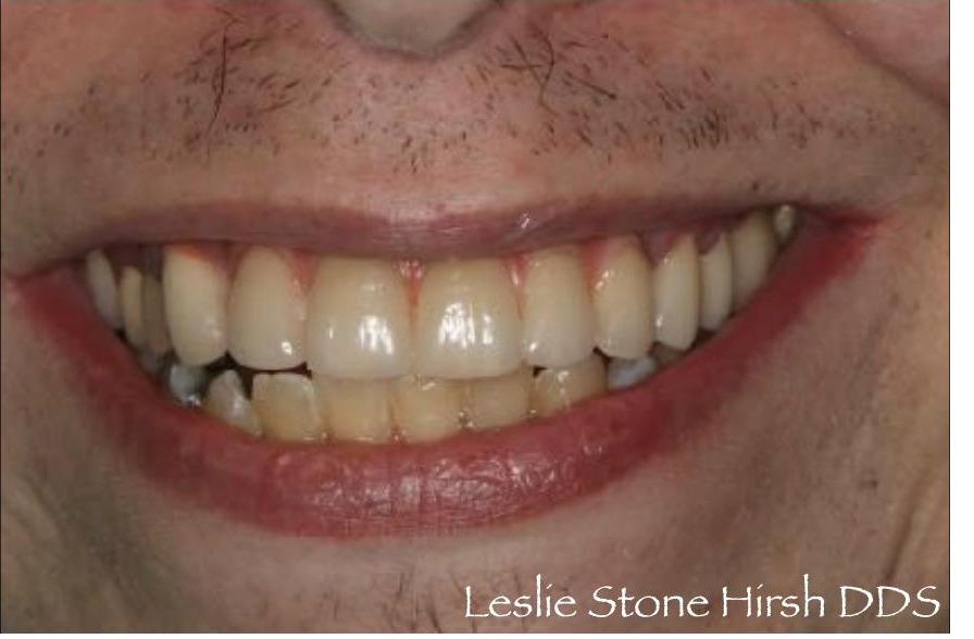 Full Mouth Rehabilitation