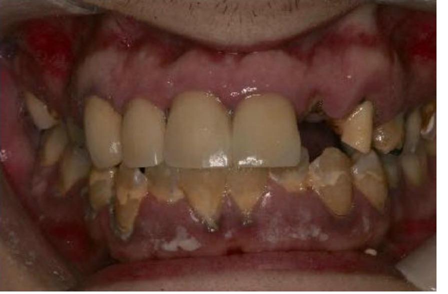 Full Mouth Rehabilitation