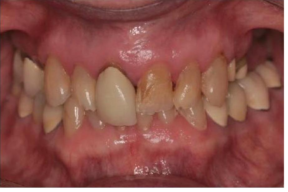 Full Mouth Rehabilitation