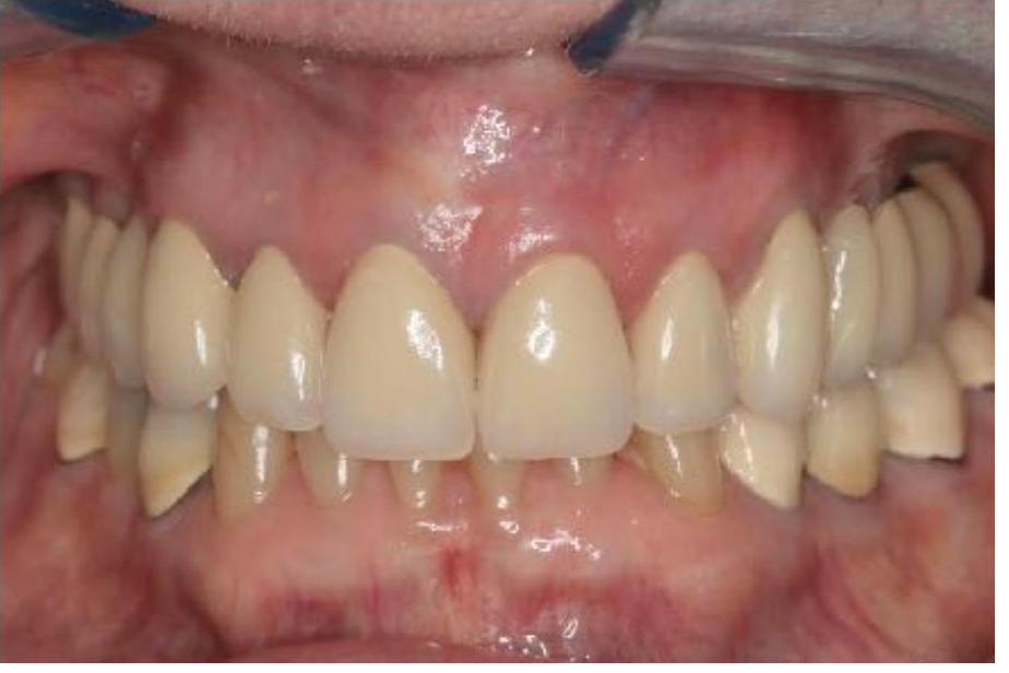 Full Mouth Rehabilitation