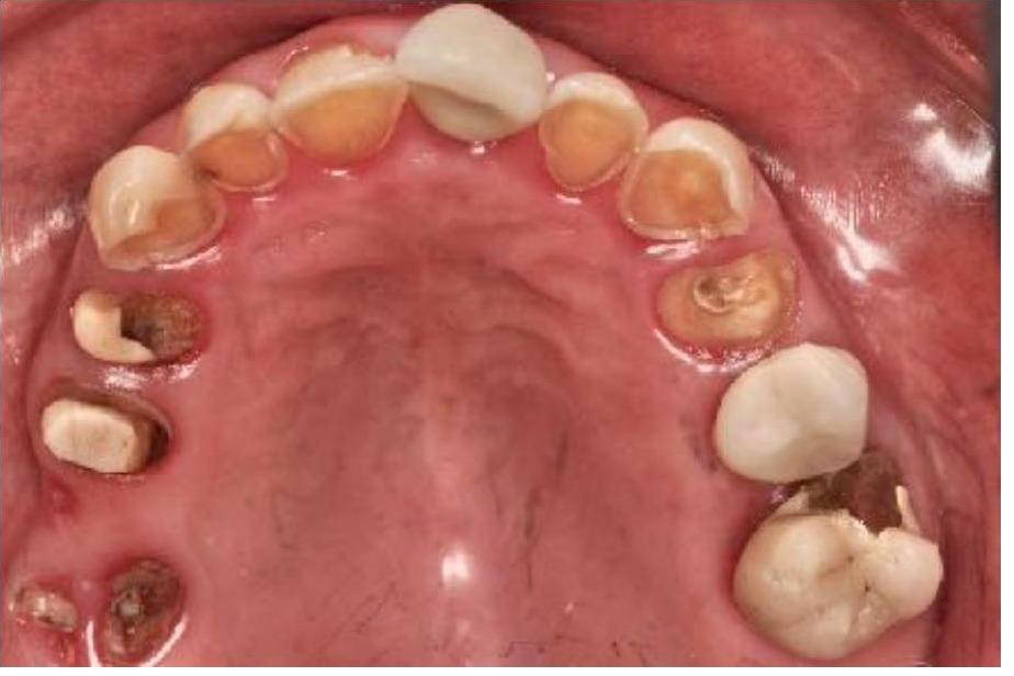 Full Mouth Rehabilitation