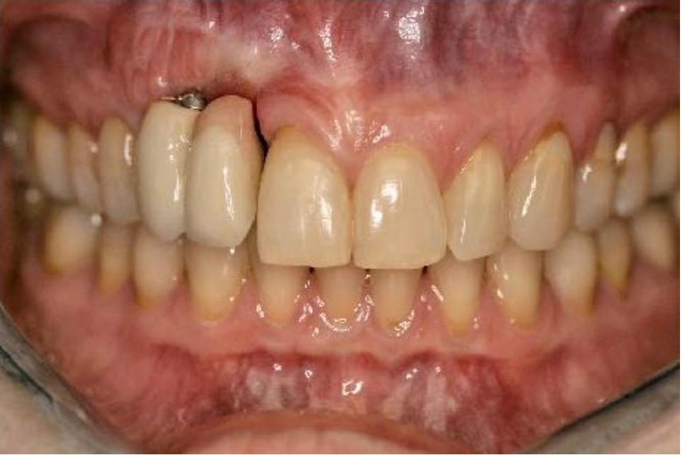 Full Mouth Rehabilitation