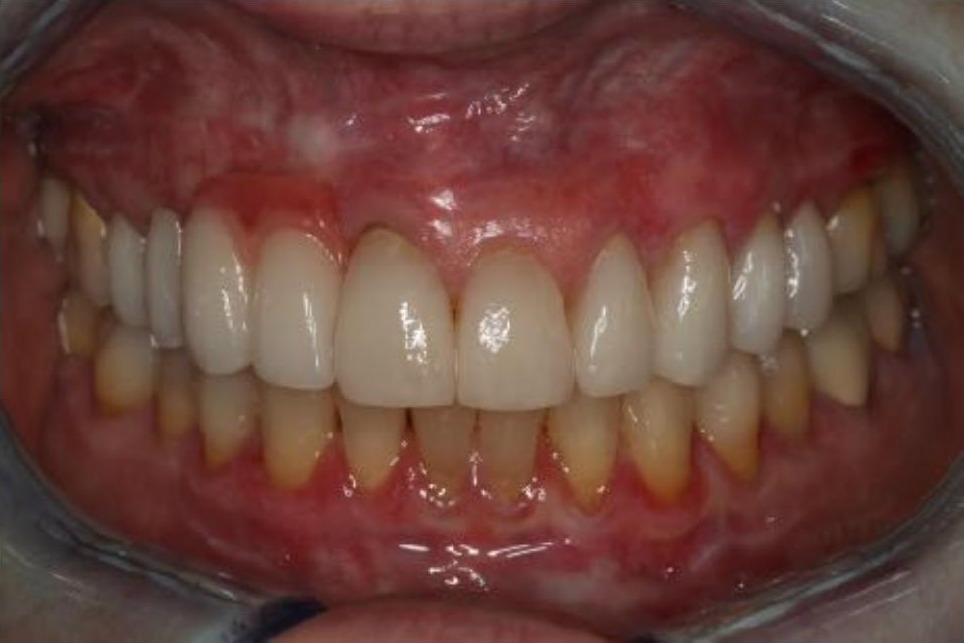 Full Mouth Rehabilitation