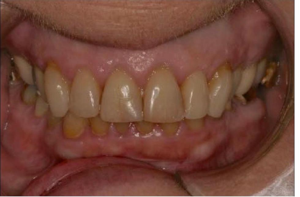 Full Mouth Rehabilitation