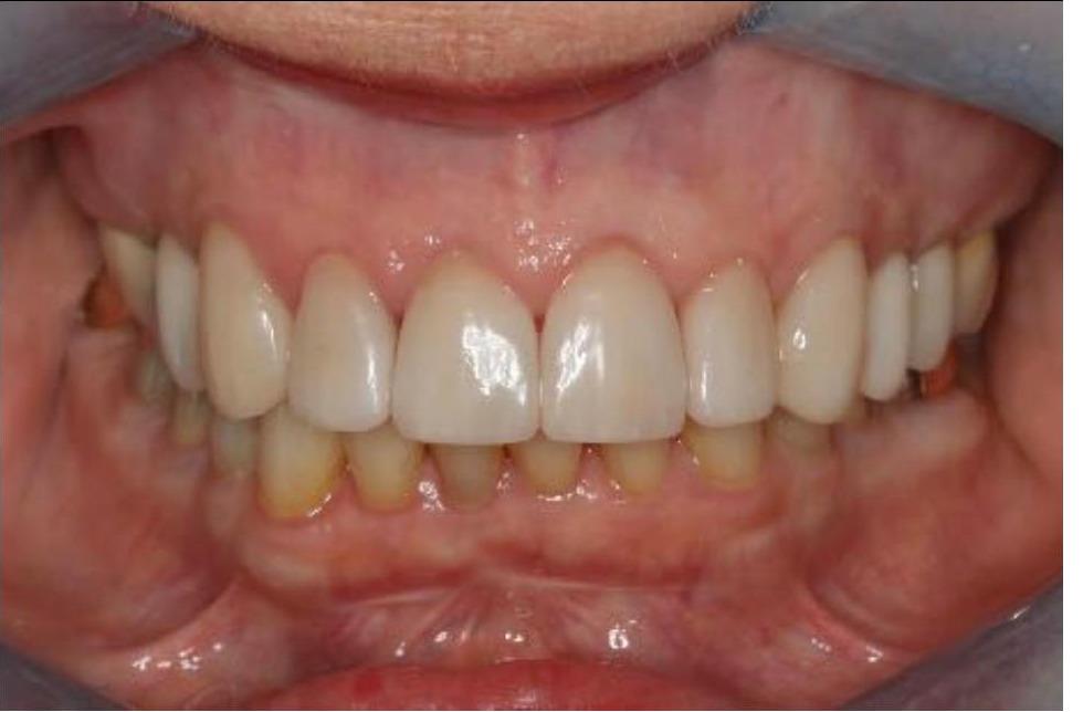 Full Mouth Rehabilitation