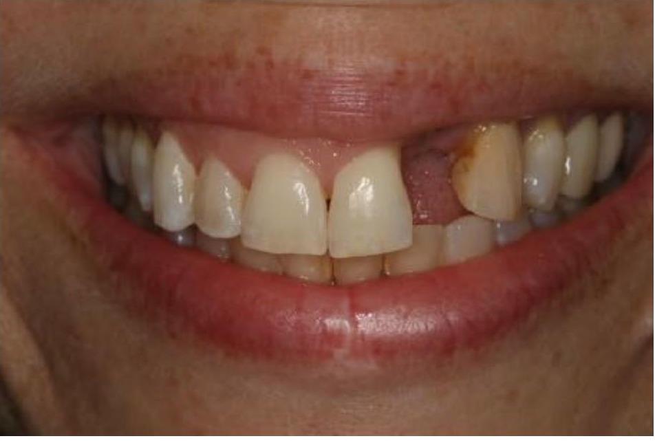 Gingival Moulage and Implant Crown