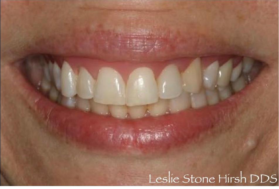 Gingival Moulage and Implant Crown