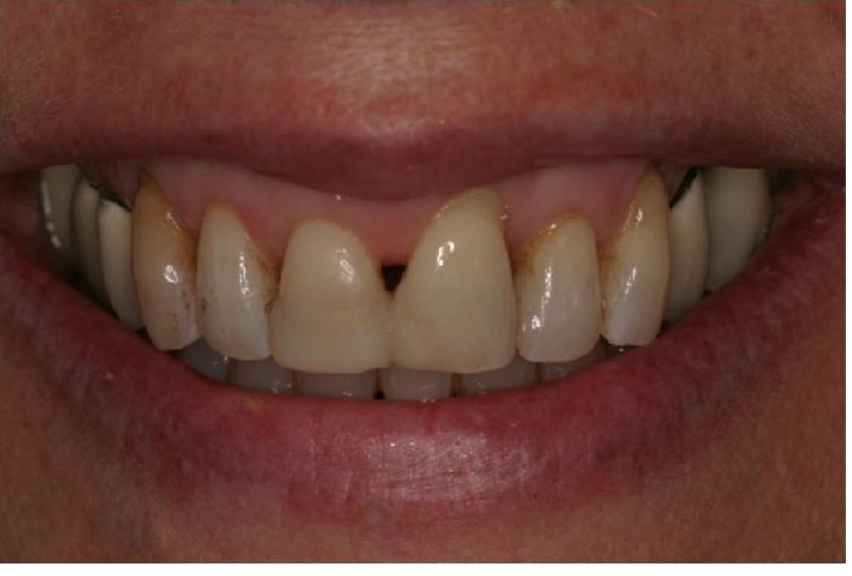 Gingival Moulage