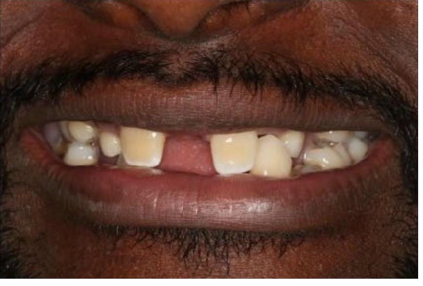 Implant Bridges and Onlays