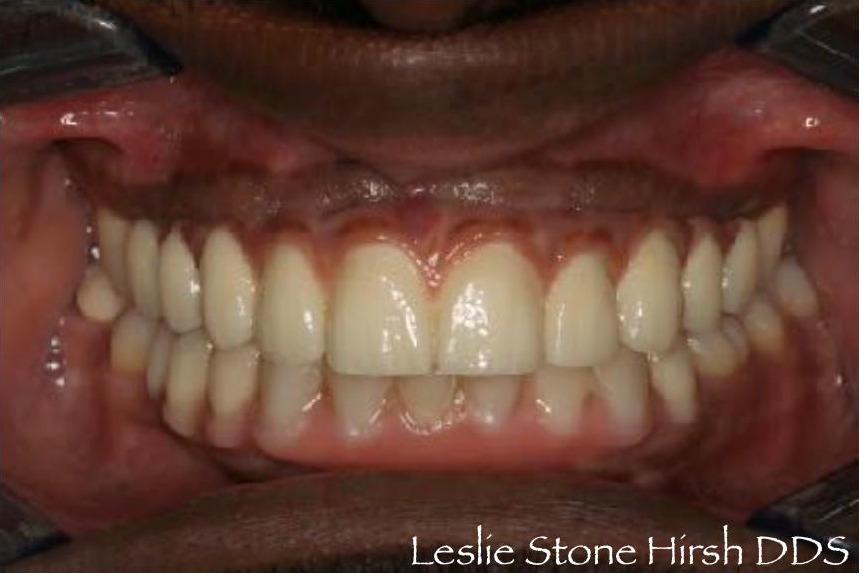 Implant Bridges and Onlays